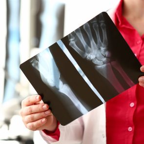 x-rays and arthritis
