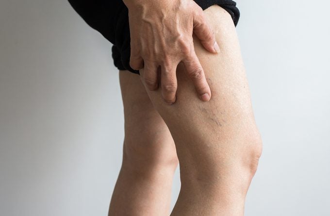 veins on mature woman's leg