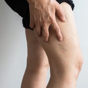veins on elderly woman's leg