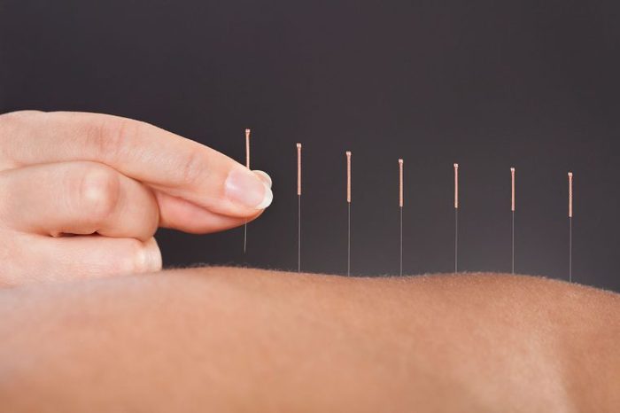 practitioner placing acupuncture needles in the arm of a patient