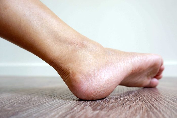 foot with dry skin on the heel