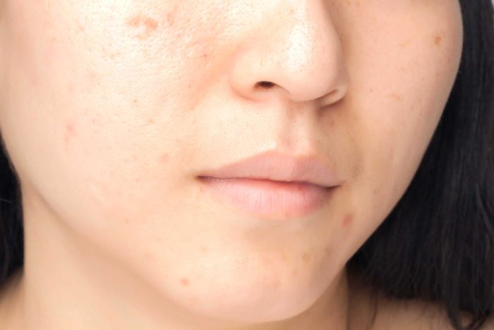 Dark spots on a woman's face.