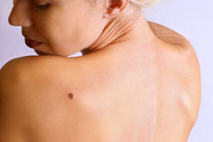 Women's bare shoulders reveal a protruding mole.