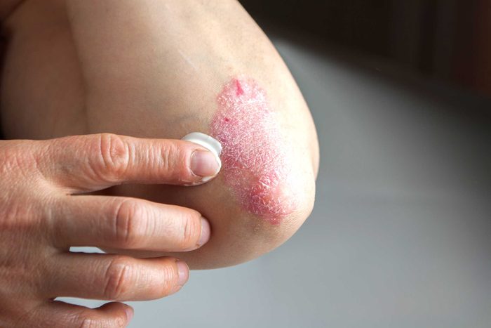 Applying ointment to psoriasis on an elbow.