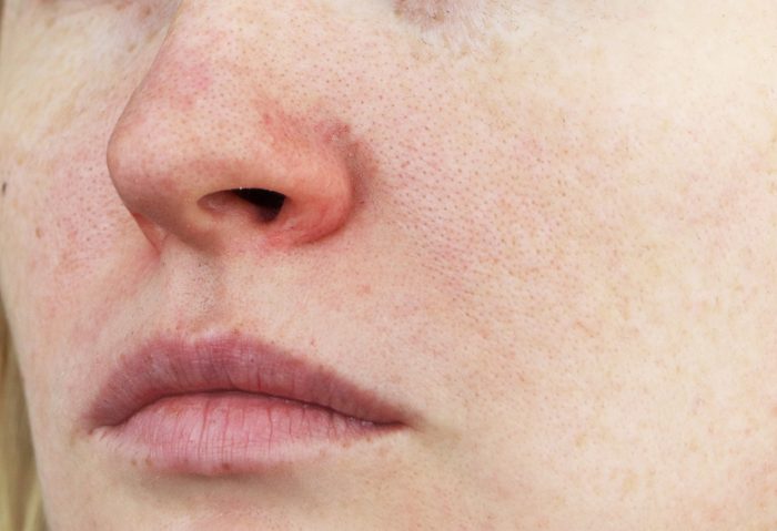 close up of redness on face