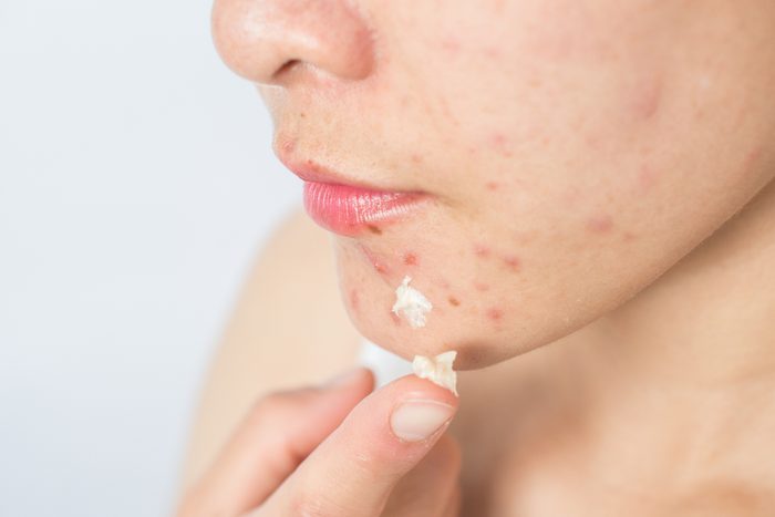 woman spot treating pimples on face