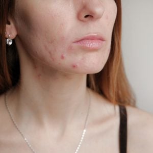cropped photo of woman with acne on face