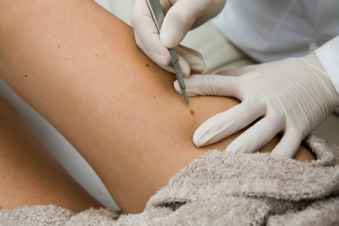 dermatologist removing a mole close up