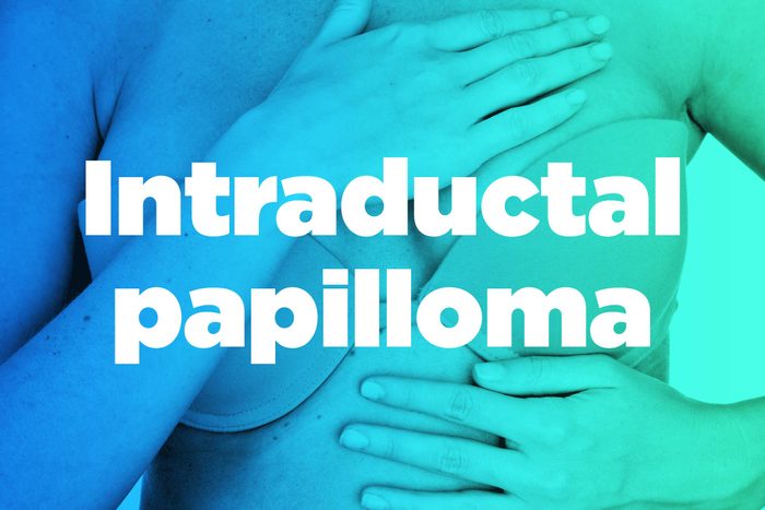 intraductal papilloma