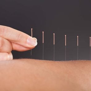 What_Is_Acupuncture