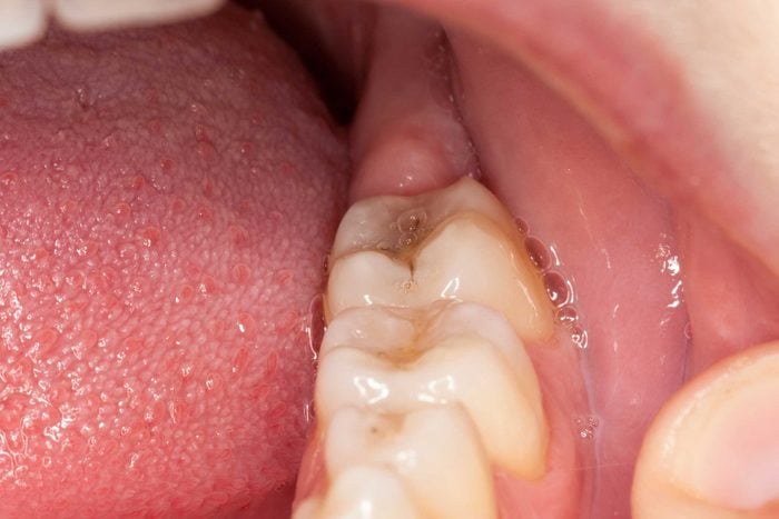 cavity in person's back molar