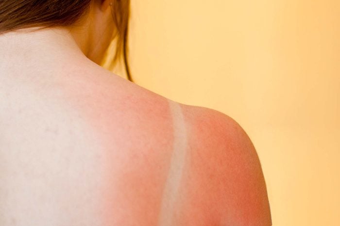 Woman with a sunburned shoulder.