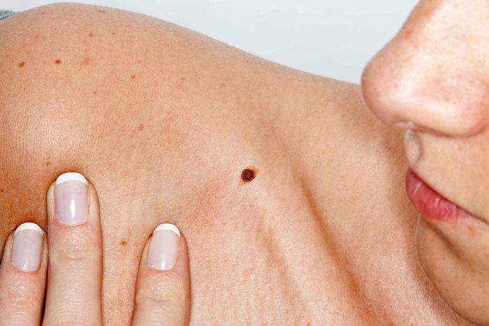 woman looking at a mole on her shoulder