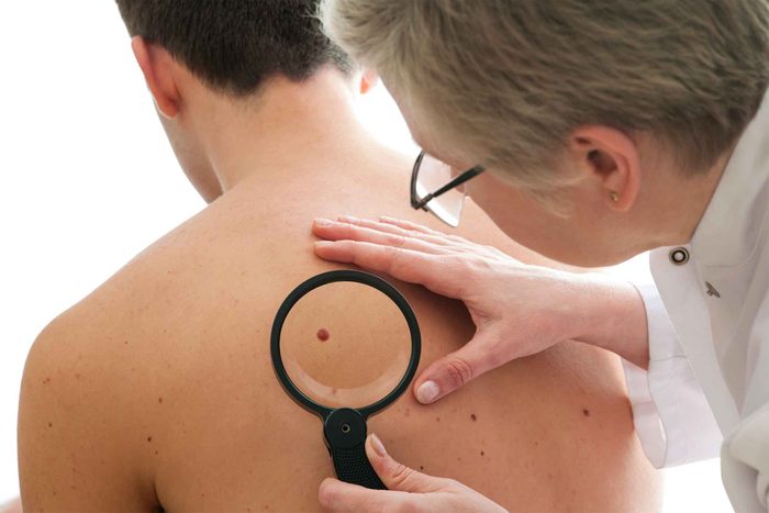 male doctor looking at mole with magnifying glass on man's back