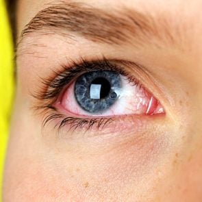 silent_signs_could_have_dry_eye_syndrome_why_can't_afford_ignore_it_redness
