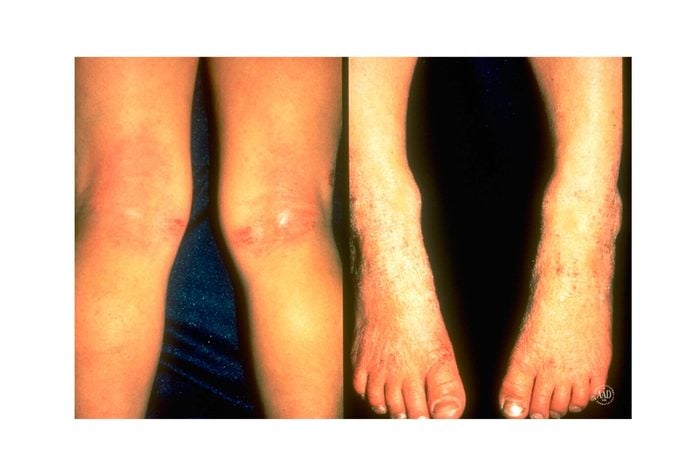 eczema on the back of the knees and on the tops of the feet