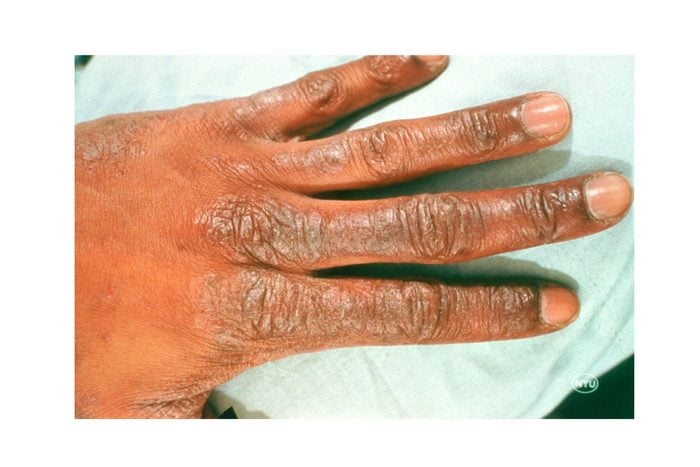 eczema on the back of the hand and fingers