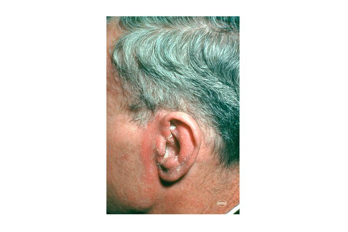 Seborrheic dermatitis on the ear