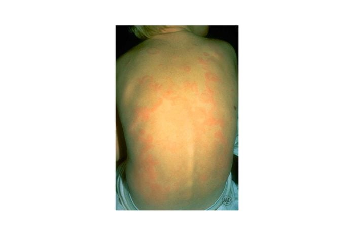 hives on the back of a young person