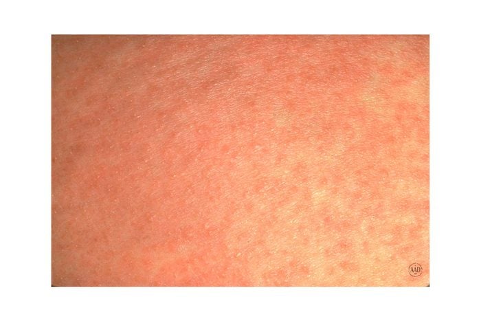 close up of heat rash bumps