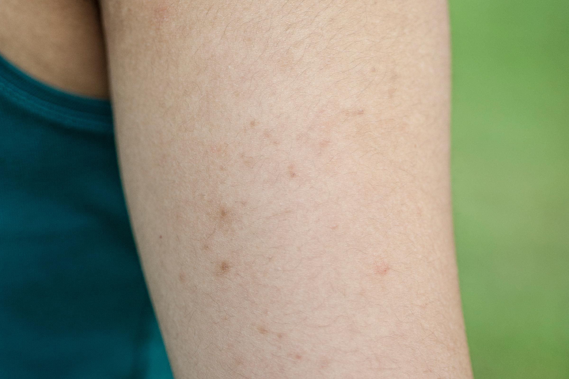 Bye, Chicken Skin! Ways to Finally Get Rid of Those Little Red Bumps on Your Arms