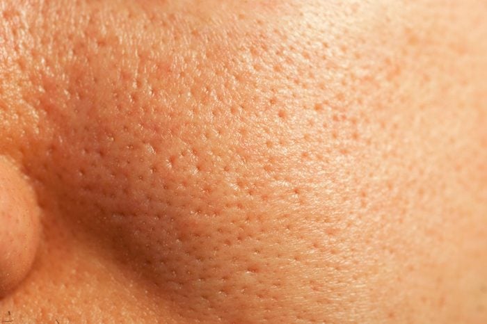 Close-up image of a person's skin with large pores.