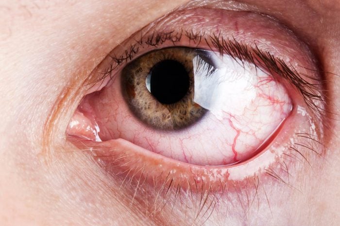 Closeup image of a person's bloodshot eye.