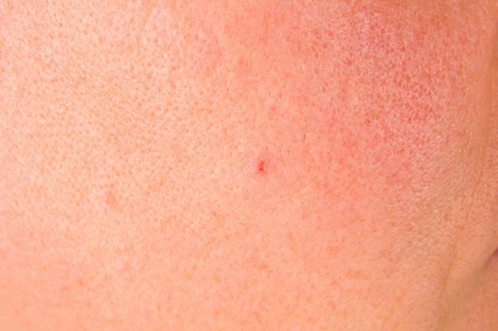 Close-up image of skin with large pores.