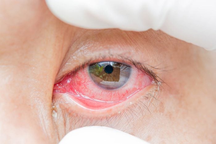 Person widening their bloodshot eye with their fingers.