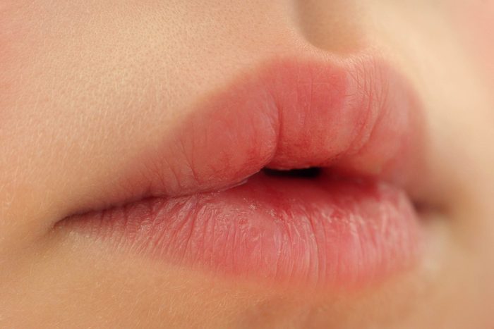 closeup of a woman's puffy, dry lips