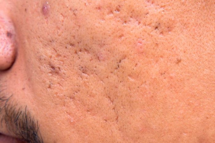 Icepick acne scars on a man's cheek.