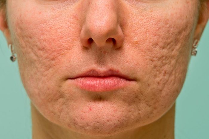 Boxcar acne scars on a woman's cheeks and chin.