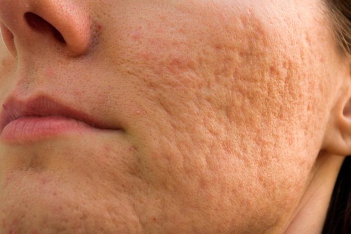 Woman's cheek that has rolling acne scars.