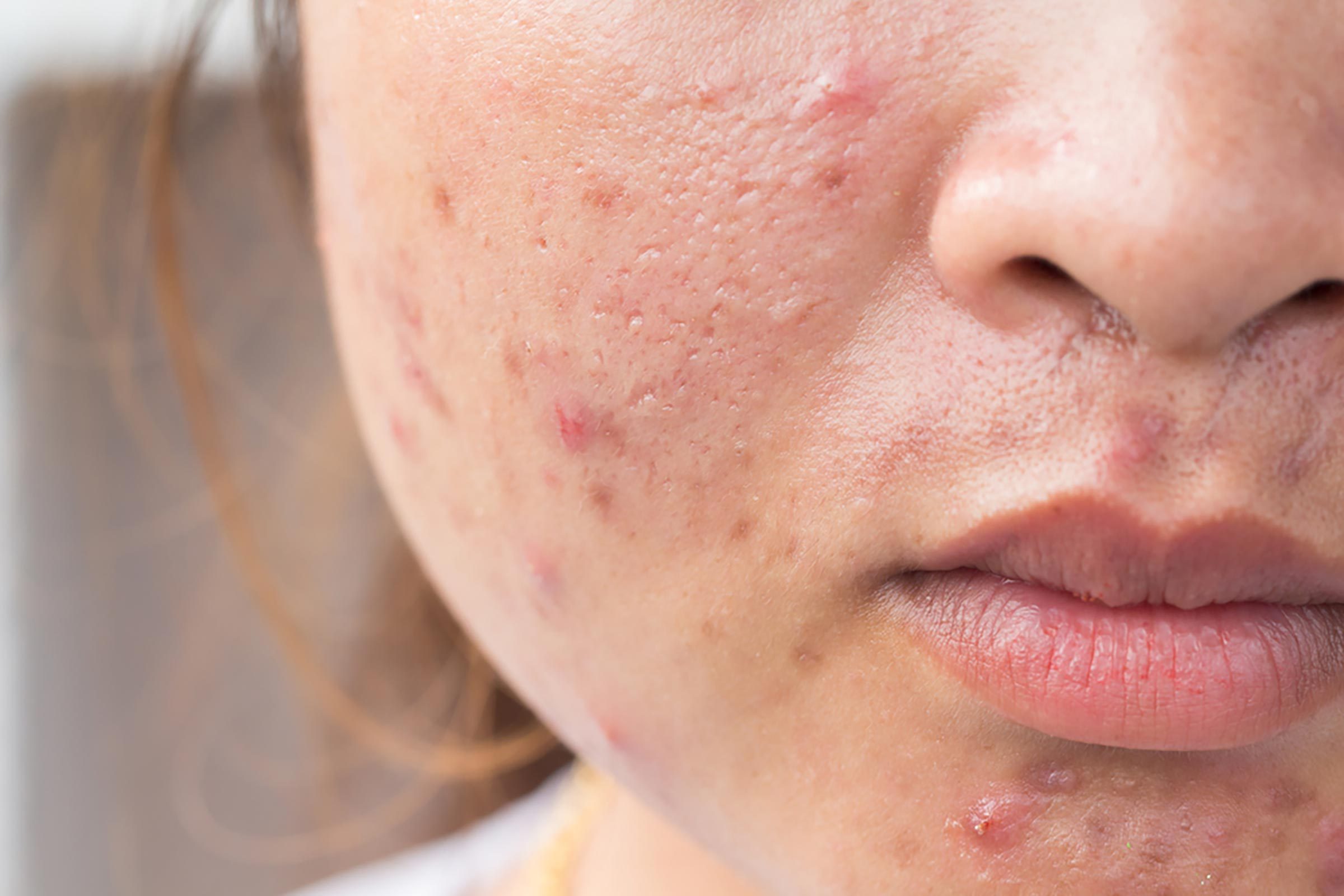 does metformin cause cystic acne