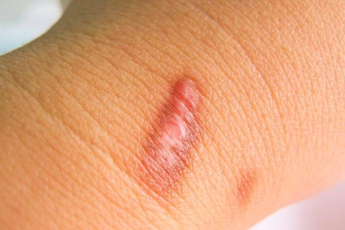 Keloid acne scar on a woman's arm.