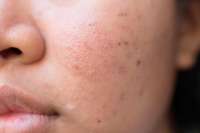 Hyperpigmentation acne scars on a woman's cheek.