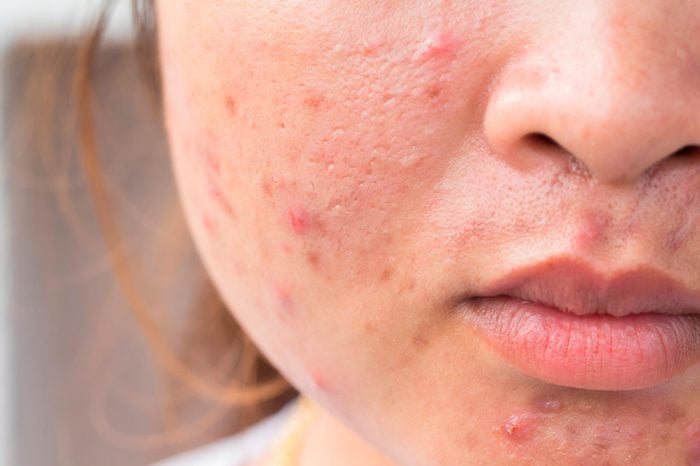 Combination acne scars on a woman's skin.
