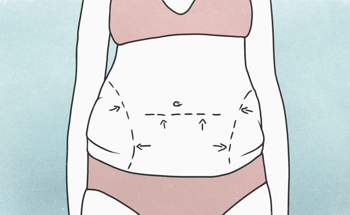 liposuction illustration