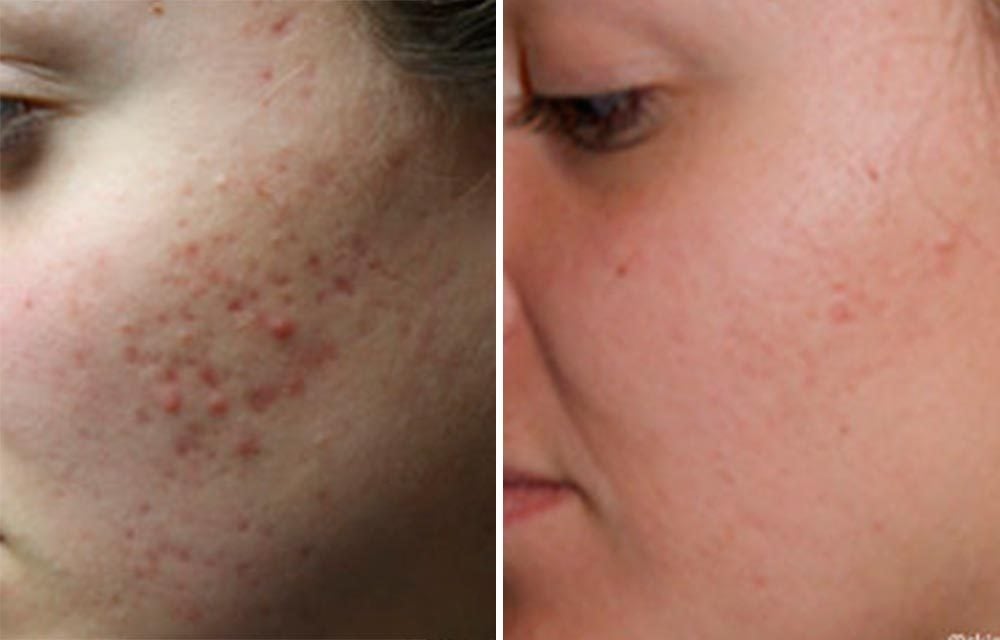trappe bent Gå tilbage Common Acne Scars and How to Get Rid of Them | The Healthy