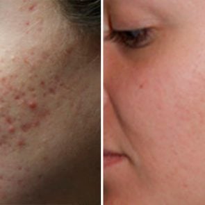 The-5-Types-of-Acne-Scars-and-How-to-Treat-Them-FT