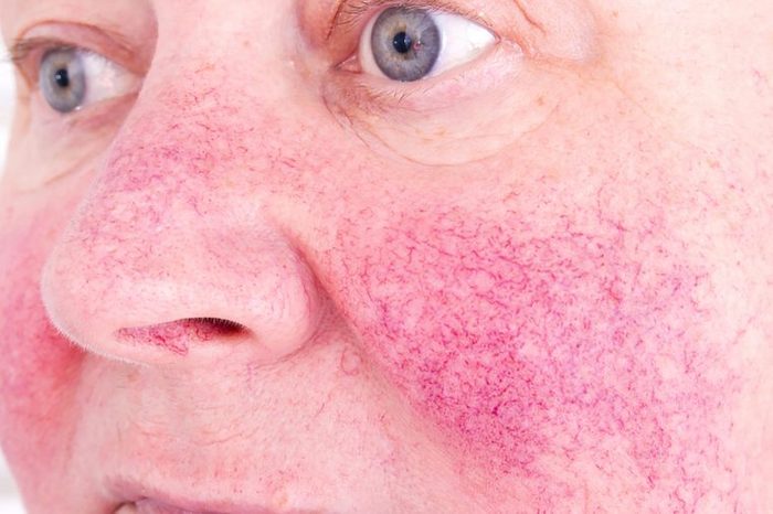 Person with rosacea on their skin (cheeks and nose).