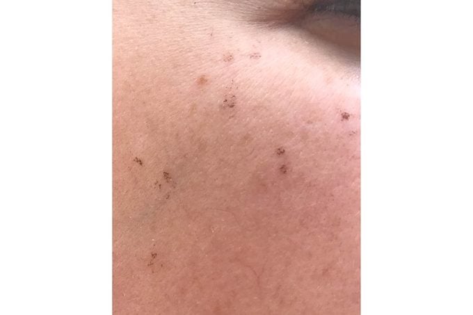 03-flaking-I-Tried-Lasers-for-Melasma—And-Here's-What-Happened