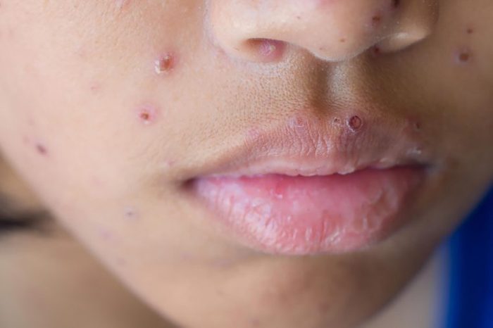 Woman with acne on her chin and cheeks.