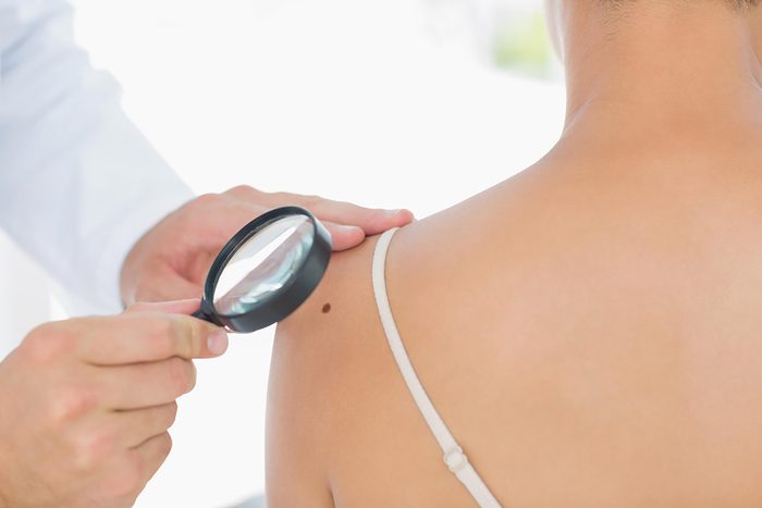dermatologist looking at skin with magnifying glass