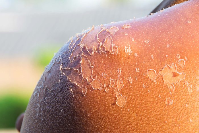 A woman's sunburned shoulder with heavily peeling skin.
