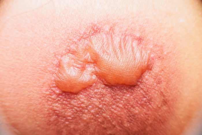 A large skin blister.