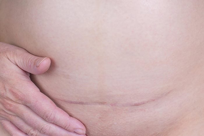 scar from c-section