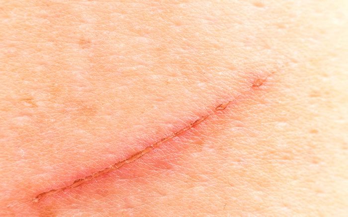 The-One-Ingredient-You-Need-to-Prevent-Scars-Hint-It's-Not-Neosporin