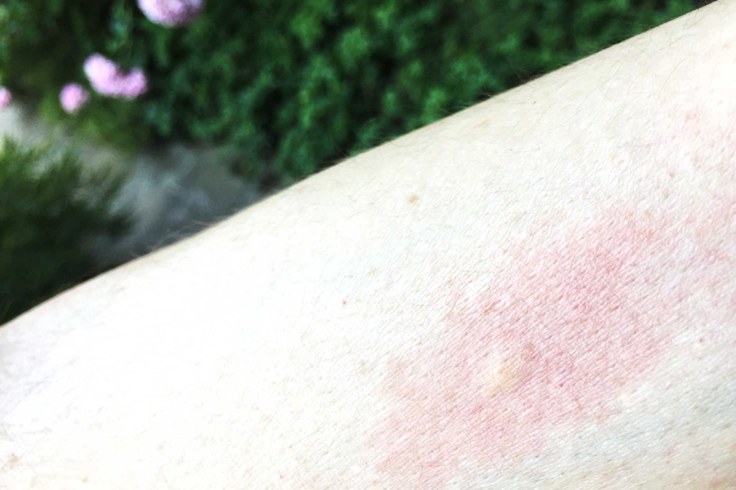 how to identify mosquito bites