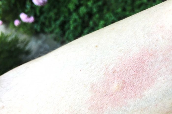 Close up of irritated mosquito bites